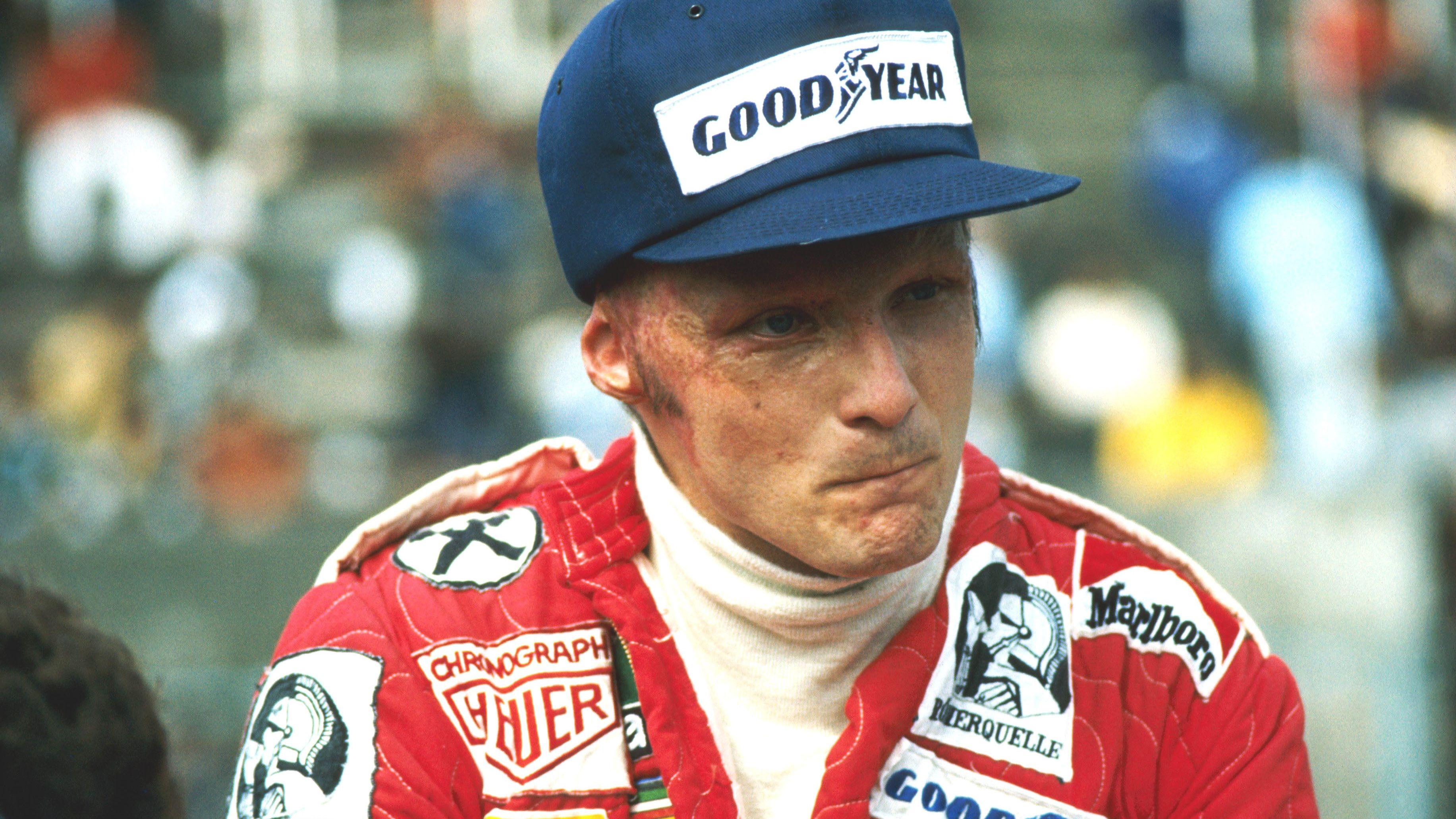 Legendarni Niki Lauda je 1976. u Monci javno pokazao ožiljke od gotovo fatalne nesreće koju je te godine doživeo na trci za Veliku nagradu Nemačke u Nurburgingu